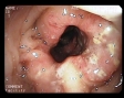 Cancer colonic